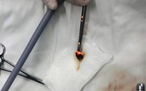 Cứu sống bé 7 tháng tuổi bị hóc hạt dưa