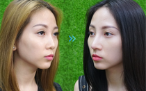 Nguyễn Thủy: “Tôi đã thực sự lột xác thần kỳ sau nâng mũi tại Thẩm mỹ NEWFACE