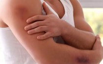 9 triệu chứng của gan nhiễm mỡ dễ thấy nhất trên da