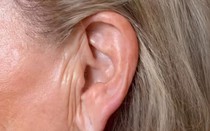 Nếp gấp ở dái tai có thể dự đoán nguy cơ đau tim, tiểu đường và đột quỵ?