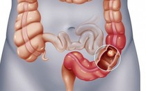 7 dấu hiệu sớm cảnh báo ung thư đại tràng