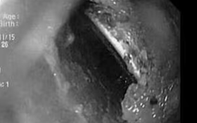 Bé trai bị loét thực quản, bác sĩ gắp ra thứ "đáng sợ" bên trong