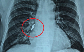 Đi làm răng về, người đàn ông ho dữ dội, bác sĩ phát hiện bí mật "đáng sợ" bên trong