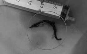 Người phụ nữ đau họng không chịu nổi, bác sĩ gắp ra thứ "đáng sợ"