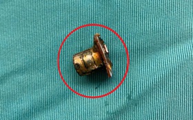 Bé 2 tuổi đang chơi bỗng ho tím tái, bác sĩ gắp ra thứ "đáng sợ" trong bụng