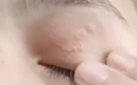 Người phụ nữ khó chịu ở mí mắt, bác sĩ gắp ra thứ "đáng sợ"