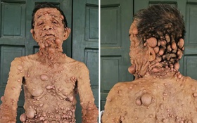 Cụ ông nổi u cục khắp người bị cắt chế độ khuyết tật: Được nhận lại trợ cấp sau phản ánh của Người Đưa Tin