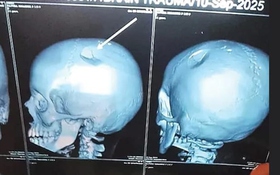 Con gái kêu đau đầu dữ dội, mẹ đưa đi chụp CT thì sốc nặng