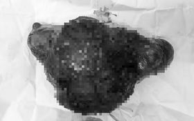 Cụ bà 72 tuổi đau âm ỉ nhiều ngày, bác sĩ sốc khi lấy ra thứ "đáng sợ" bên trong bụng