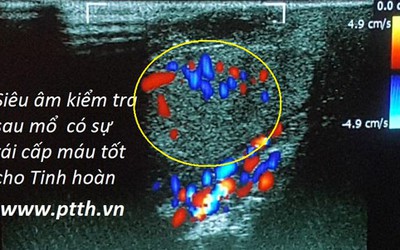 VN lần đầu nối ghép thành công hai tinh hoàn đứt rời cùng dương vật