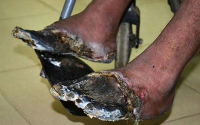 3 thói quen xấu khiến tay chân bị hủy hoại và biến dạng khủng khiếp