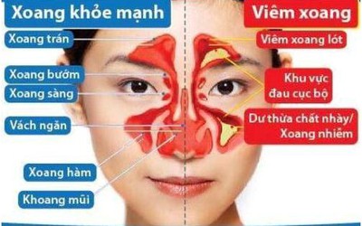 Hết viêm xoang nhờ bài thuốc trăm năm tuổi của lương y dân tộc Mường