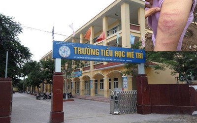 Hà Nội: Cô giáo đánh tím bầm tay học sinh, thầy Hiệu trưởng nói gì?