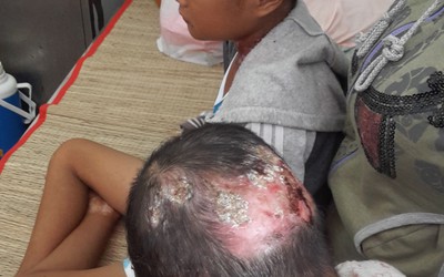 Xót xa hai đứa trẻ trong một gia đình mắc 'bệnh lạ' - da cánh bướm