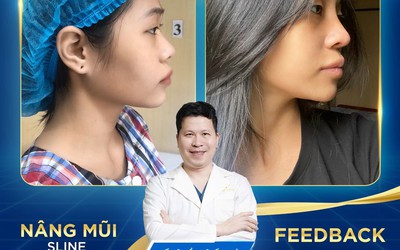 Nâng mũi Hàn Quốc và nâng mũi S Line - nên chọn phương pháp nào tại Thẩm mỹ Như Hoa?