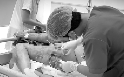 Nguy kịch sau khi tự trích mụn nhọt tại nhà