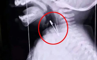 Chụp X-quang họng bé trai 7 tháng tuổi, bác sĩ sốc nặng khi phát hiện "bí mật" đáng sợ