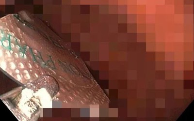 Người đàn ông 52 tuổi nhập viện trong tình trạng đau bụng, bác sĩ phát hiện lý do "đáng sợ" phía sau