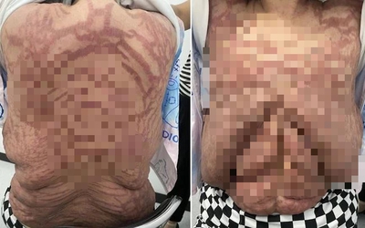 Người phụ nữ 40 tuổi, da biến dạng kinh hoàng vì sai lầm nhiều người mắc