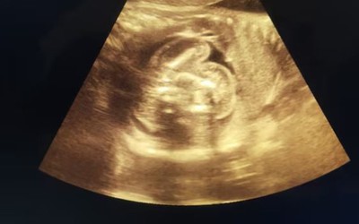 Bác sĩ sốc nặng khi phát hiện bé trai vừa chào đời đã "mang thai"