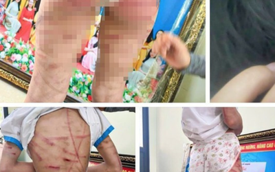 Vụ bé gái lớp 5 bị cha dượng bạo hành: Công an thông tin chính thức