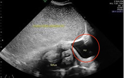Thai phụ 26 tuổi kêu đau dạ dày, bác sĩ sốc nặng khi phát hiện "bí mật" đáng sợ