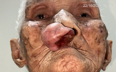 Phẫu thuật cho cụ bà gần 100 tuổi sau 30 năm sống chung với khối u trên mặt