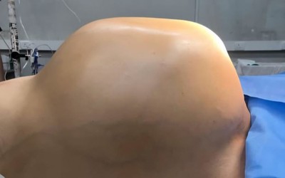 Bụng của người đàn ông sưng to bất thường, bác sĩ lấy ra thứ "đáng sợ" bên trong