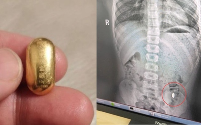 Con trai nuốt miếng vàng của mẹ vào bụng và cái kết