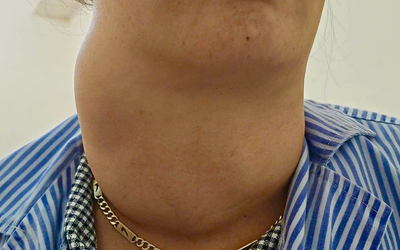 Người phụ nữ 41 tuổi với chiếc cổ "khổng lồ"