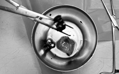 Bé trai 4 tuổi đau bụng dữ dội, nôn ói, bác sĩ gắp ra thứ "đáng sợ" bên trong