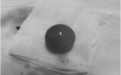 Bé trai 14 tháng tuổi nôn nhiều, bố mẹ bất ngờ khi bác sĩ gắp ra thứ "đáng sợ" trong bụng