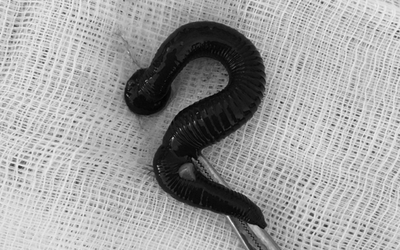 Cụ bà 72 tuổi ngứa mũi liên tục, bác sĩ gắp ra thứ "đáng sợ" bên trong