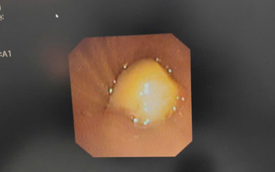 Bé hơn 2 tuổi xẹp phổi vì nuốt phải thứ hạt "vạn người mê"