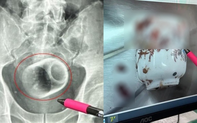 Người đàn ông bị chướng bụng, bác sĩ phát hiện ra bí mật đáng sợ