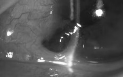 Người đàn ông 27 tuổi đau mắt dữ dội, bác sĩ gắp ra thứ "đáng sợ" bên trong