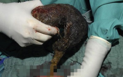 Bé gái đau bụng suốt 10 tháng, bác sĩ phát hiện ra "bí mật" đáng sợ