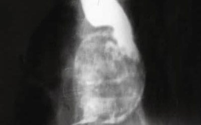 Người phụ nữ bị khó nuốt, bác sĩ phát hiện ra "bí mật" đáng sợ