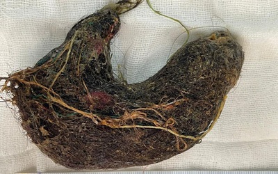 Bé trai đau bụng suốt 2 tháng, bác sĩ phát hiện ra "bí mật" đáng sợ