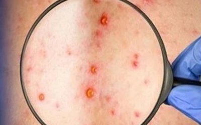 Đồng Nai ghi nhận ca mắc đậu mùa khỉ chưa rõ nguồn lây