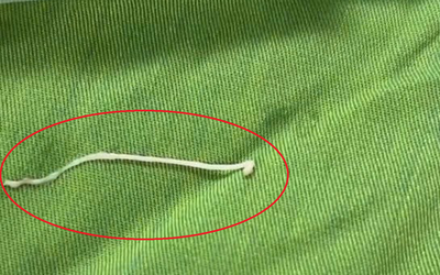 Đau bụng âm ỉ, đến viện bác sĩ gắp ra thứ "đáng sợ" bên trong