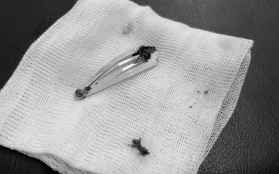 Bé gái 6 tuổi được cô giáo đưa đến viện, bác sĩ gắp thứ dài 7cm trong bụng