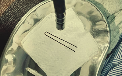 Bé gái 4 tuổi đột ngột khóc thét, vào viện bác sĩ gắp ra thứ "đáng sợ" bên trong