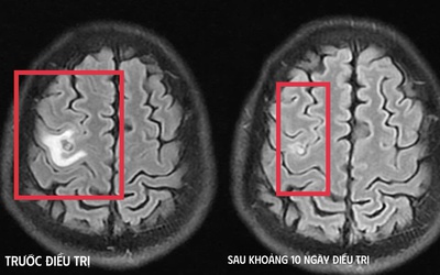 Cơn co giật bất thường hé lộ “vị khách lạ” ký sinh trong não