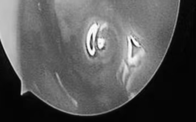 Bé trai hơn 2 tuổi chảy mũi hàng ngày, bác sĩ phát hiện ra "bí mật" đáng sợ