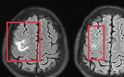 Người đàn ông 39 tuổi đau đầu, bác sĩ phát hiện thứ "đáng sợ" bên trong