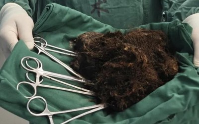 Người phụ nữ bụng "cứng như đá", bác sĩ phát hiện ra bí mật đáng sợ