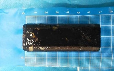 Người đàn ông đau bụng dữ dội, bác sĩ gắp ra thứ "đáng sợ"