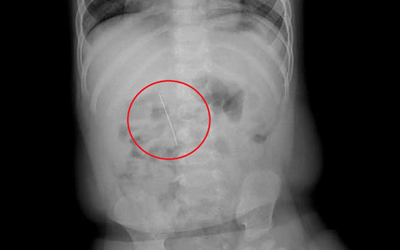 Bé trai 11 tháng khó chịu trong người, bác sĩ gắp ra thứ "đáng sợ"