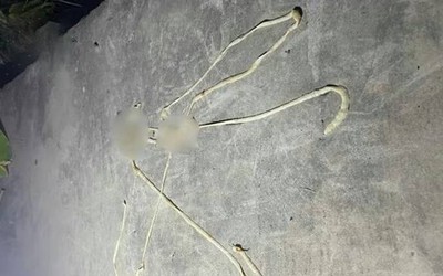 Bị rối loạn tiêu hóa, người đàn ông phát hiện "vật thể lạ" dài gần 10m